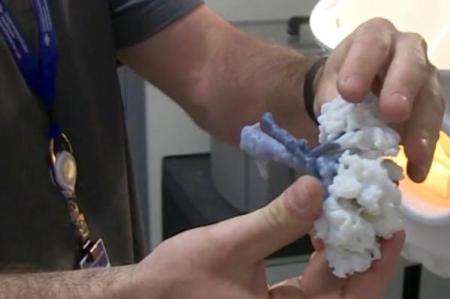 خارج کردن تومور از کلیه با کمک چاپ سه بعدی خارج کردن تومور از کلیه با کمک چاپ سه بعدی