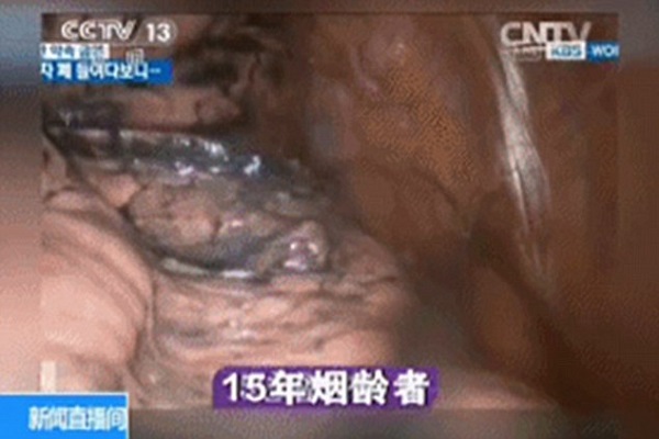 تاثیر سیگار کشیدن بر ریه&zwnj;ها به روایت تصویر