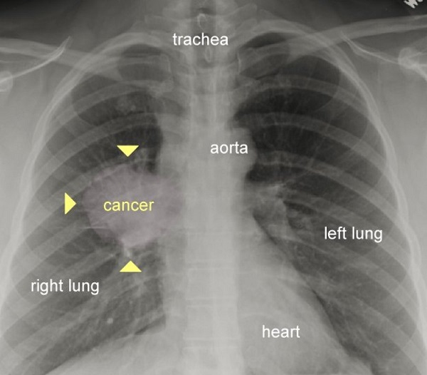 تاثیر سیگار کشیدن بر ریه&zwnj;ها به روایت تصویر