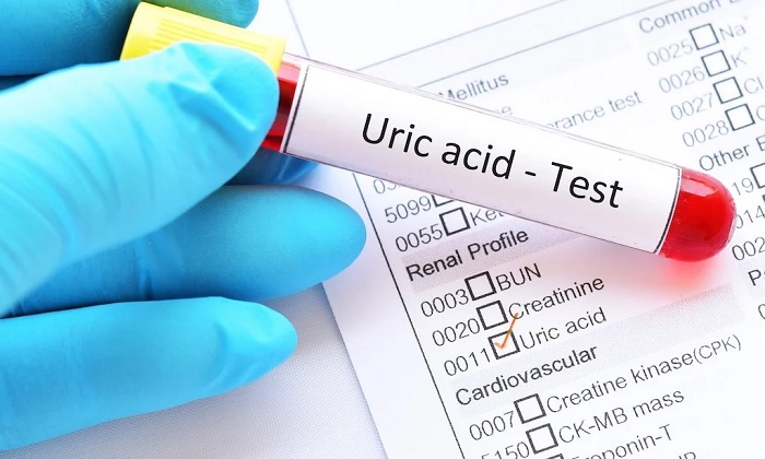 اسید اوریک و 6 روش طبیعی برای کاهش آن اسید اوریک و 6 روش طبیعی برای کاهش آن