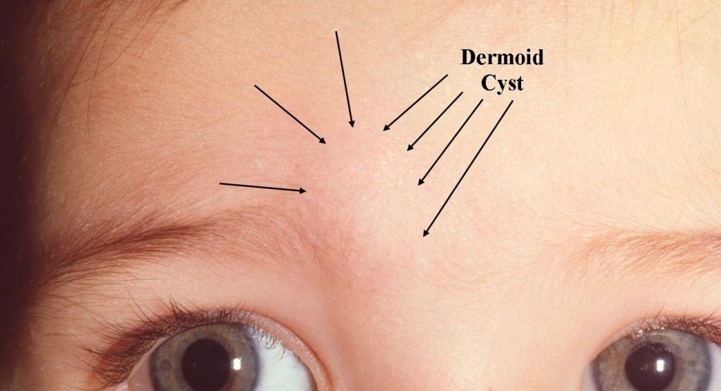 از سیر تا پیاز کیست درموئید