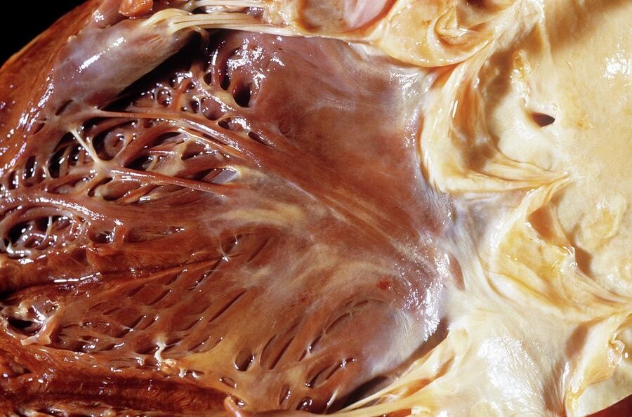 از قلبی که با چربی پوشیده شده تا تهدید سلامت انسان از قلبی که با چربی پوشیده شده تا تهدید سلامت انسان