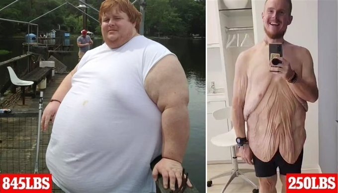 بلایی که کاهش وزن بر سر بدن جوان آمریکایی آورد + عکس بلایی که کاهش وزن بر سر بدن جوان آمریکایی آورد + عکس