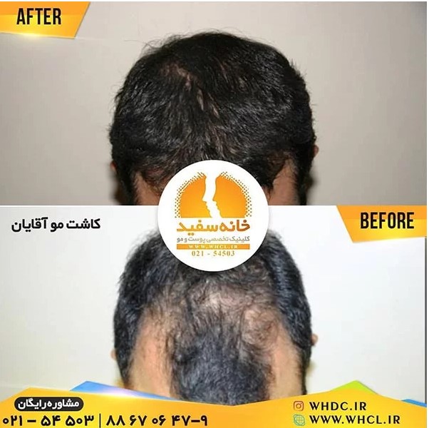 کاشت مو به روش میکروگرافت