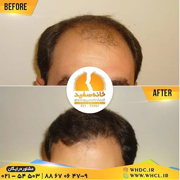 کاشت مو به روش میکروگرافت