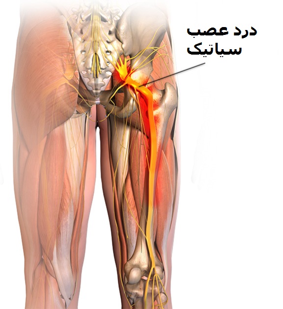 از انواع درد پا تا علل هر یک از آنها از انواع درد پا تا علل هر یک از آنها