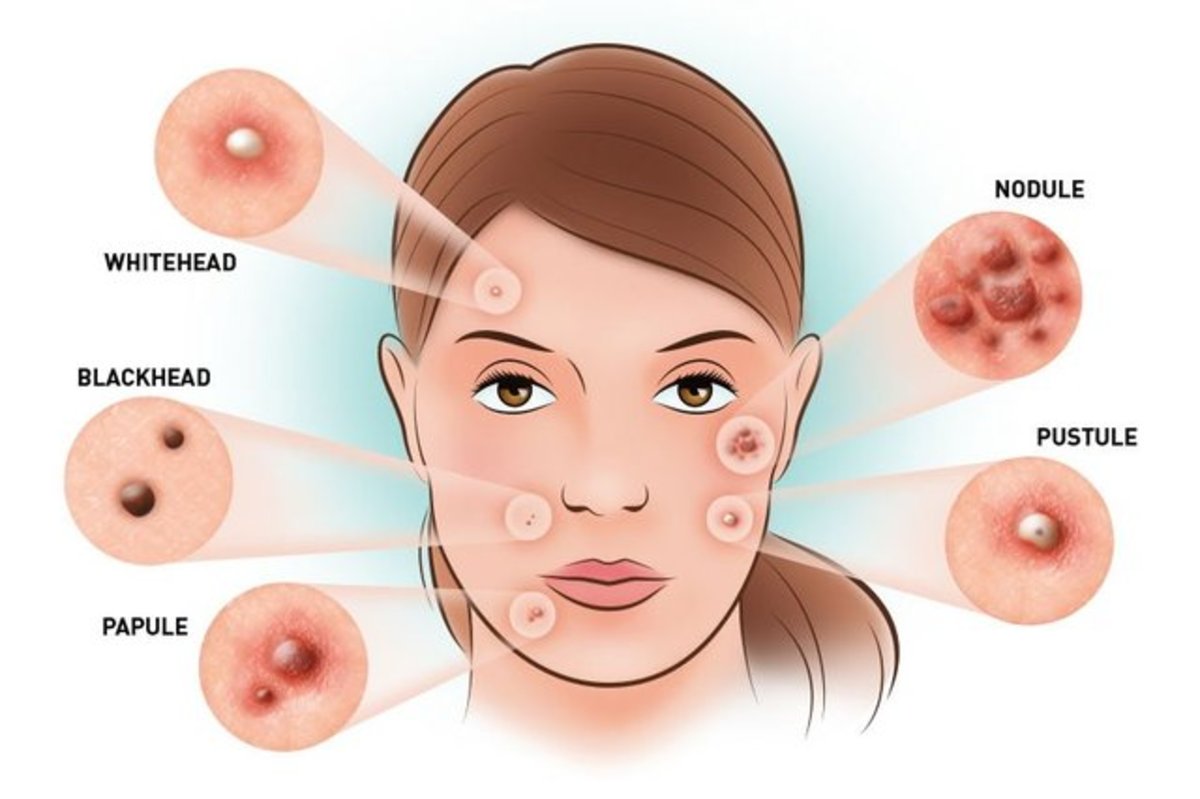 شستشوی بیش از حد صورت دلیل بروز آکنه است؟