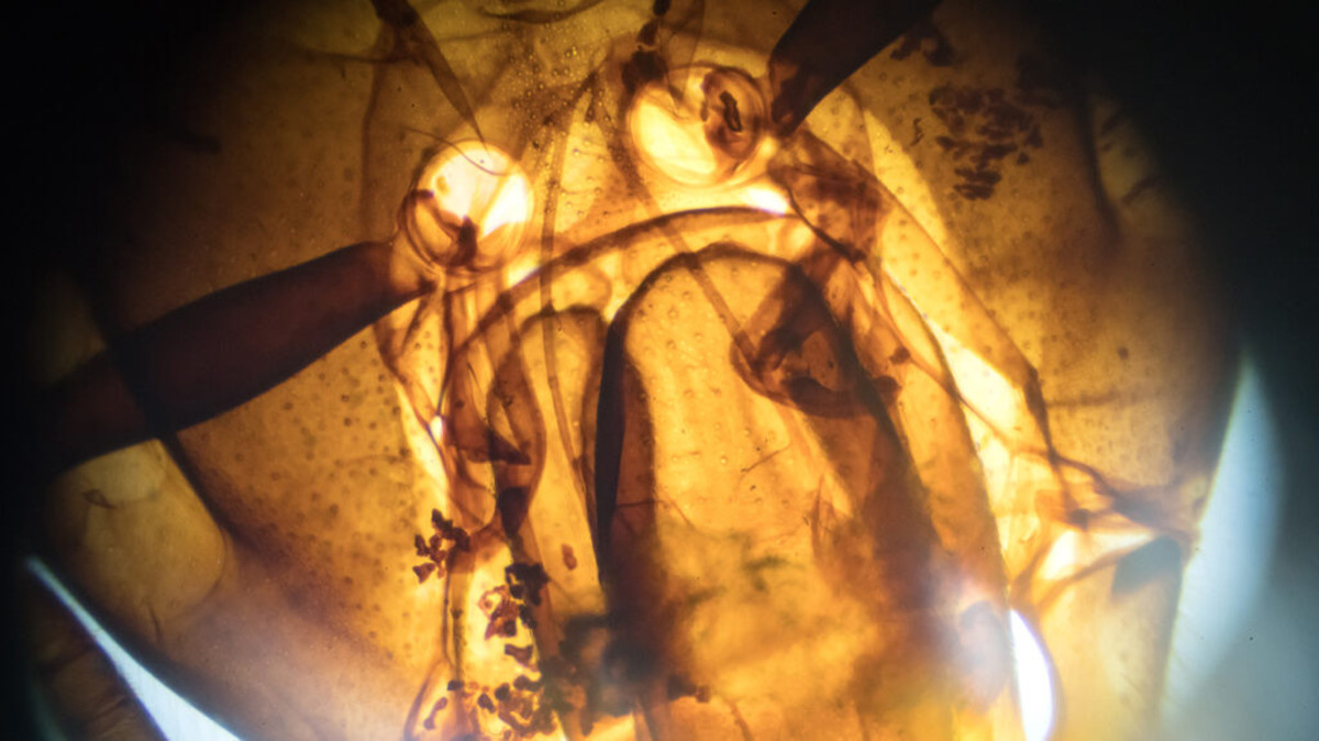 زهر زنبور عسل در برابر سلول های تهاجمی سرطان سینه!