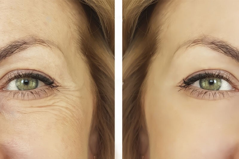 همه چیز در مورد چین و چروک دور چشم