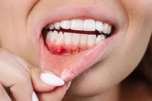 مکمل‌های طبیعی؛ جایگزین آنتی‌بیوتیک در درمان بیماری شدید لثه