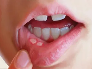 زخم‌های دردناک دهان از کجا می‌آیند؟/ دلایل شایع و راه‌های کاهش درد و پیشگیری