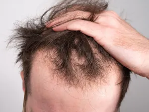 راهکاری مناسب برای مقابله با ریزش موی ژنتیکی