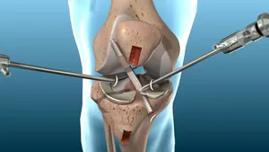 پارگی رباط صلیبی فقط برای ورزشکاران نیست؛ این نکته را جدی بگیرید