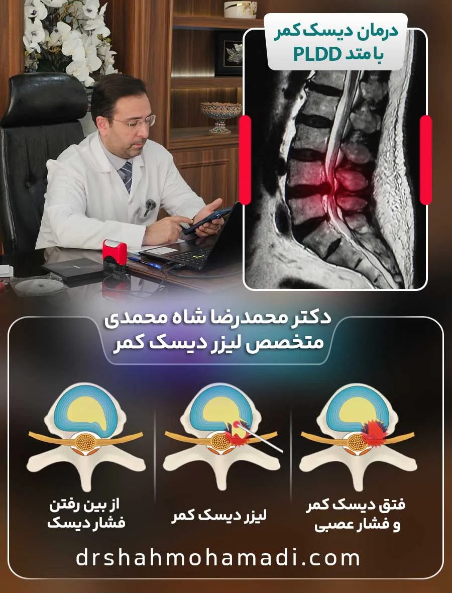 درمان دیسک کمر با لیزر