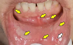 پمفیگوس چیست و چه علائمی دارد؟