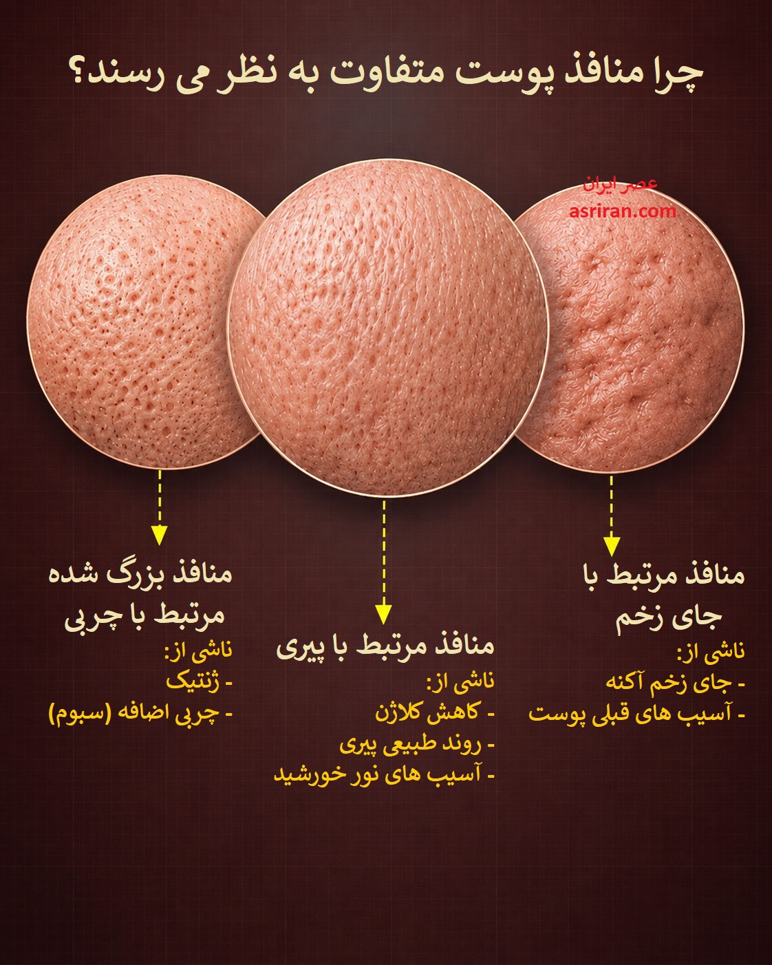 اینفوگرافیک مقایسه ظاهر منافذ پوست اینفوگرافیک مقایسه ظاهر منافذ پوست