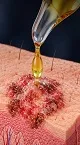 آیا ترکیب ویتامین ث و DMSO جایگزین جراحی سرطان پوست می شود؟