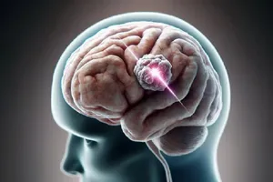 روش جدید برای تخمین طول عمر افراد دارای تومور مغزی