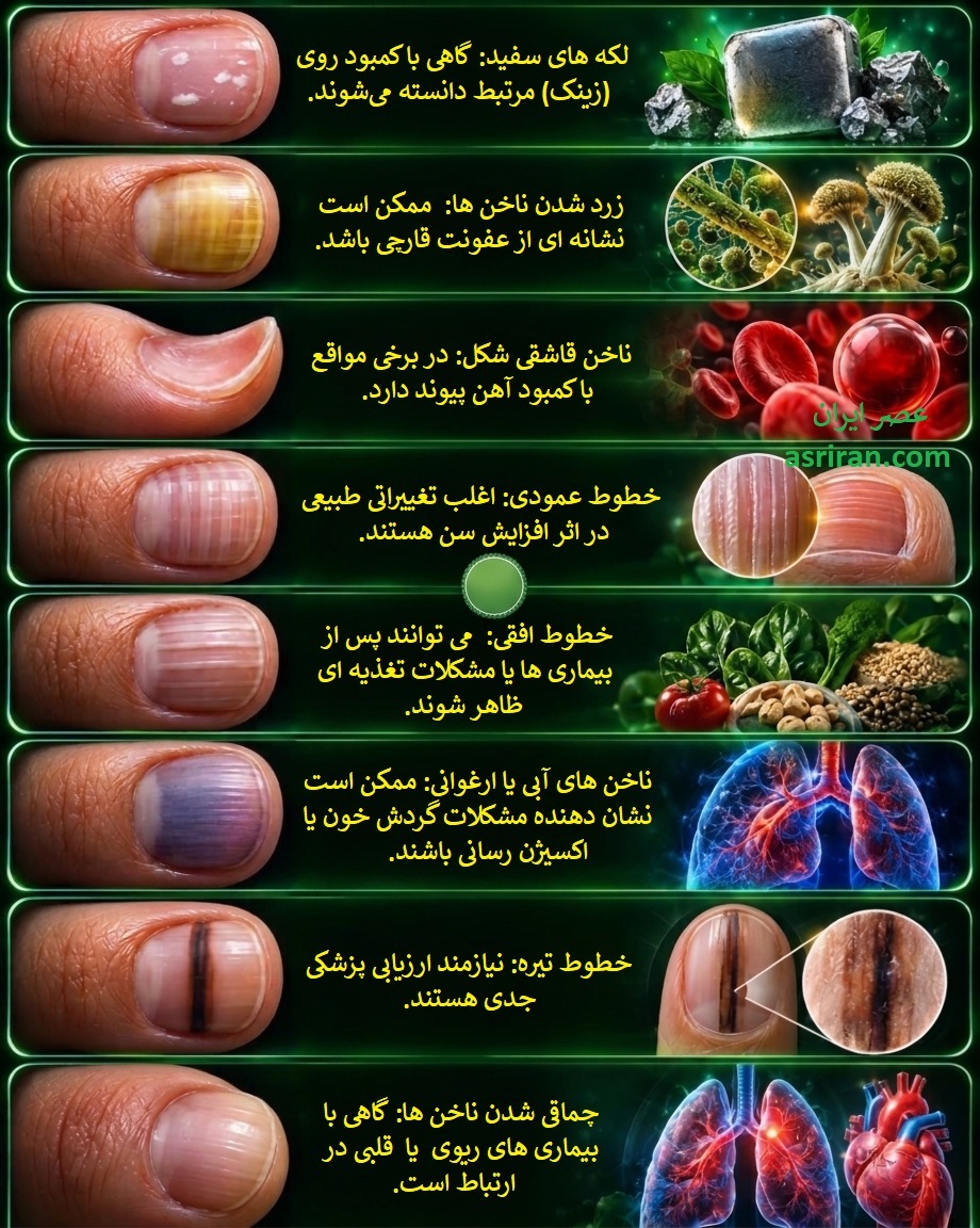 اینفوگرافیک تغییرات ناخن چه بیماری ها و کمبودهایی را لو می دهند؟ اینفوگرافیک تغییرات ناخن چه بیماری ها و کمبودهایی را لو می دهند؟