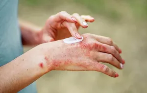 راه‌های پیشگیری از ابتلا به اگزما