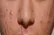 از تستوسترون تا آکنه؛ این هورمون چه رابطه ای با پوست دارد؟