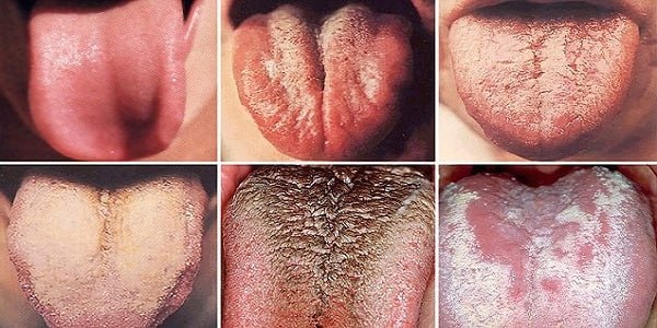 رنگ زبان چه چیزهایی درباره سلامت ما می گوید؟ رنگ زبان چه چیزهایی درباره سلامت ما می گوید؟