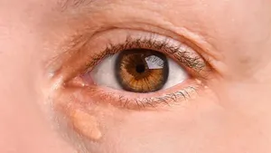 نشانه هشداردهنده حمله قلبی و سکته مغزی ممکن است روی صورت ظاهر شود