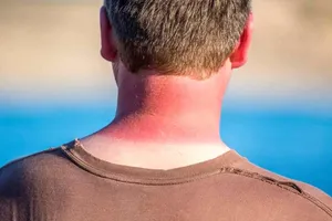 مراقب آفتاب‌سوختگی باشید