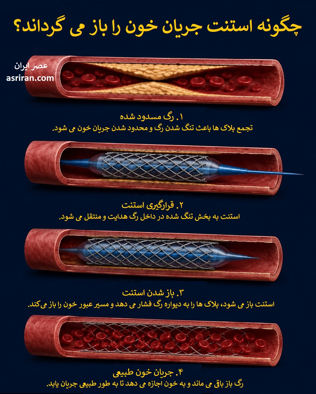 اینفوگرافیک چگونه استنت جریان خون را بازمیگرداند اینفوگرافیک چگونه استنت جریان خون را بازمیگرداند